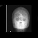 Fracture of orbital floor, tear-drop figure, hemosinus: X-ray - Plain radiograph